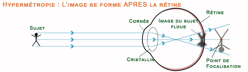 hypermetropie
